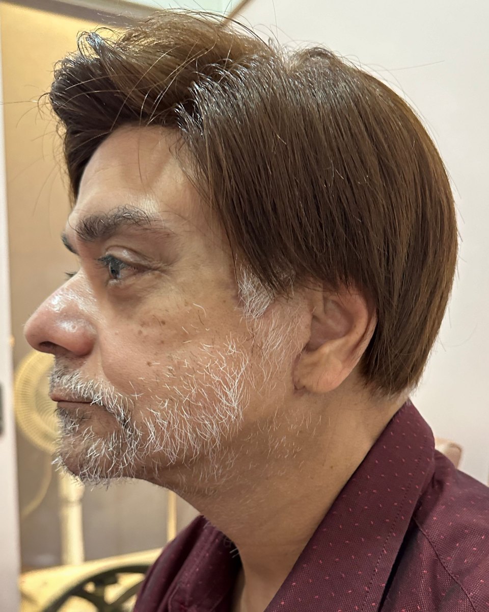 안면거상·목거상 후기 — 측면 수술 5주차