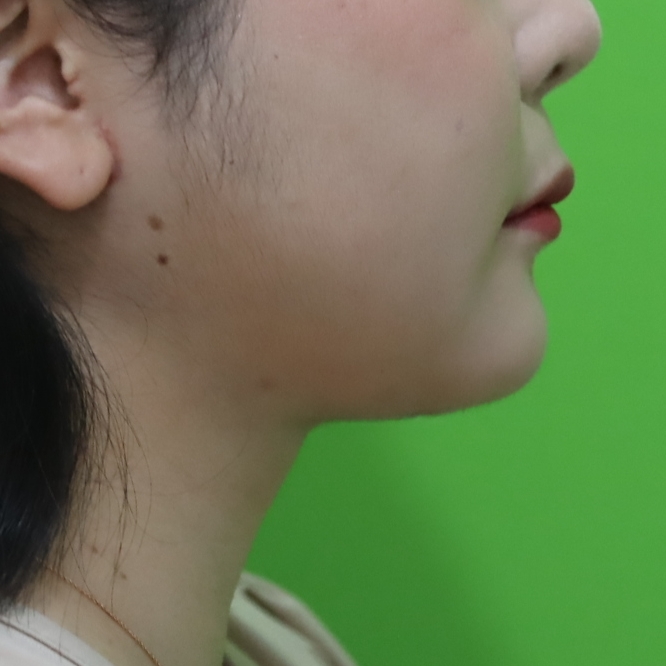 목거상술 케이스 #1 수술 3개월 후 — 29세 여성