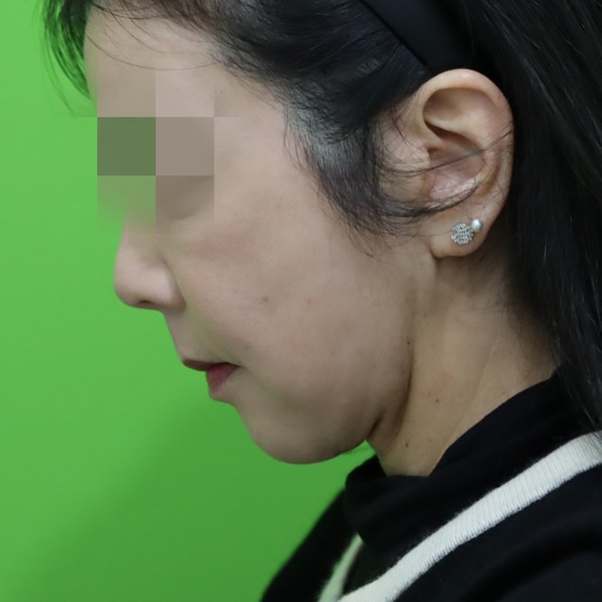 안면거상·목거상 케이스 #2 수술 5개월 후 측면(고개 숙임) — 59세 여성