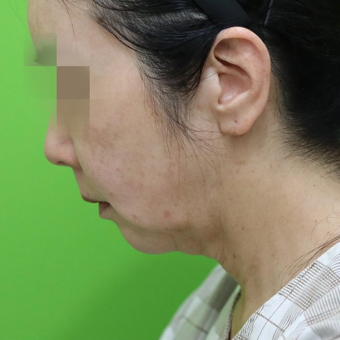 안면거상·목거상 케이스 #2 수술 전 측면(고개 숙임) — 59세 여성