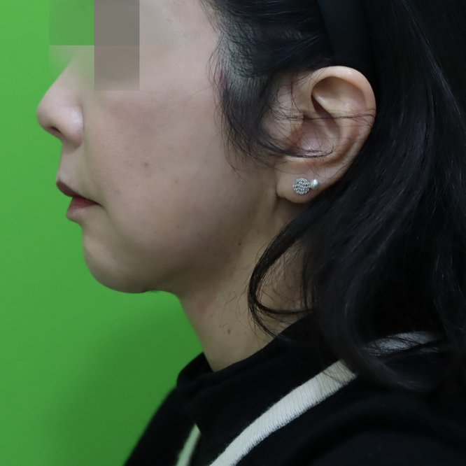 안면거상·목거상 케이스 #2 수술 5개월 후 측면(고개 정면) — 59세 여성