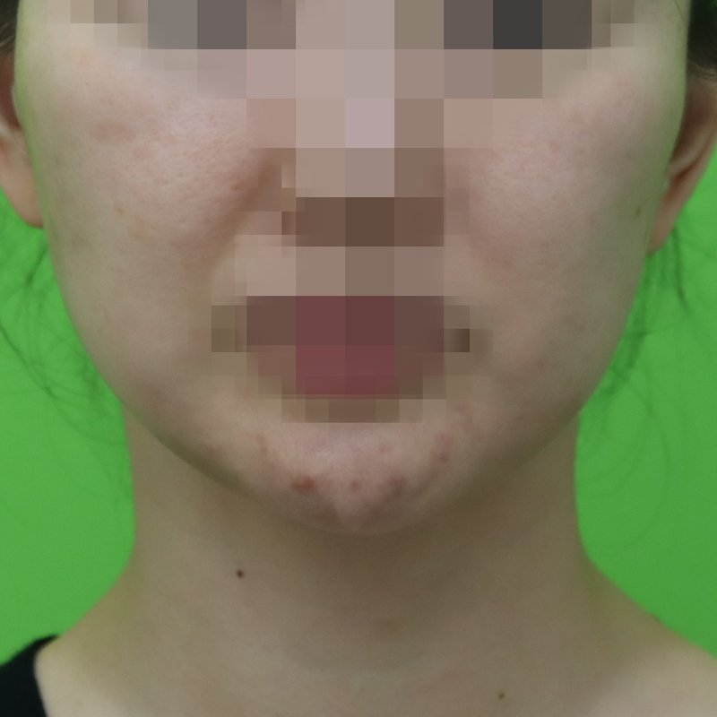 안면거상·목거상 Case #3 수술 9개월 후 정면 — 30대 후반 여성