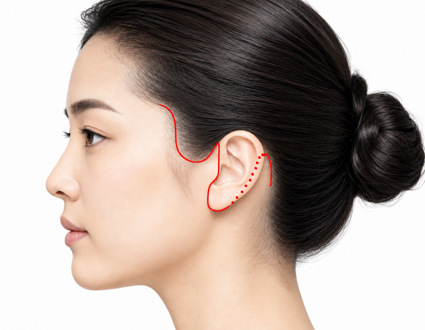 Facelift incision lines - along the temporal hairline, natural pre-auricular curves, and post-auricular line