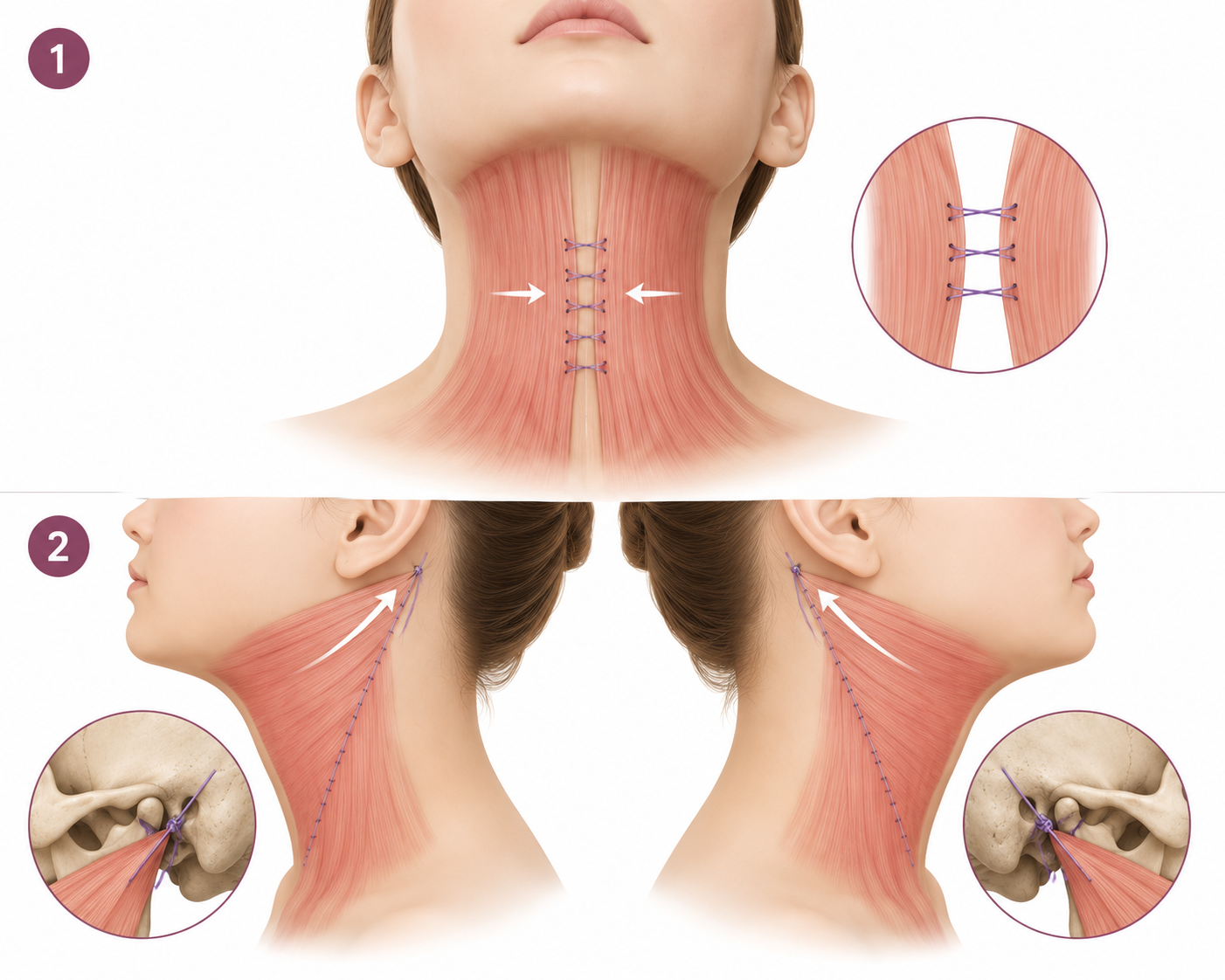 Bilateral platysma repair — midline plication plus bilateral lateral suspension to the mastoid bone, lifting both the central neck bands and the sagging submental tissue