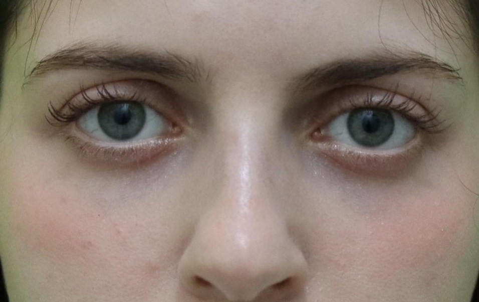 Transconjunctival fat repositioning 5 months post-op (Female, 26, Case #1)