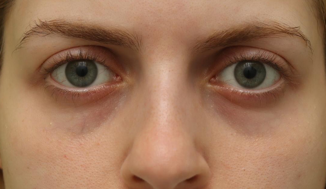 Transconjunctival fat repositioning before surgery (Female, 26, Case #1)