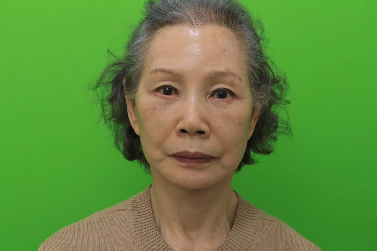 Facelift, neck lift, brow lift, lower blepharoplasty 5 weeks post-op (Female, 81, Case #1)