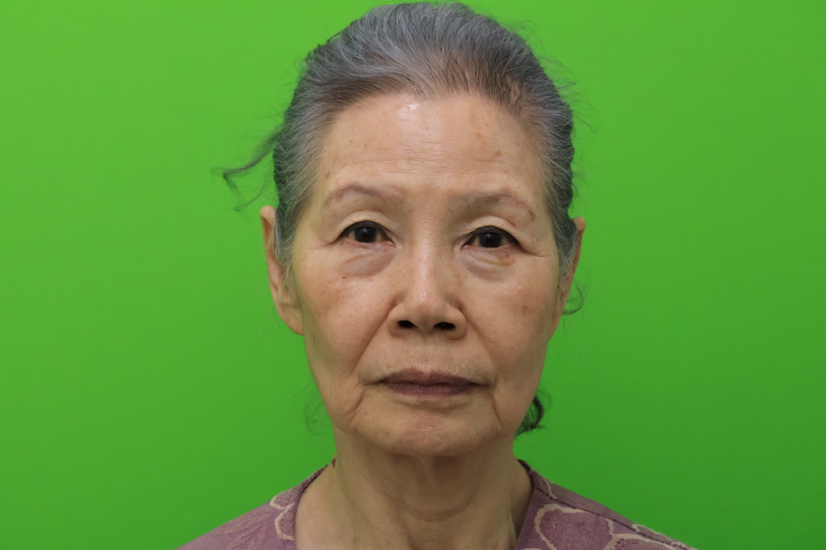 Facelift, neck lift, brow lift, lower blepharoplasty before surgery (Female, 81, Case #1)